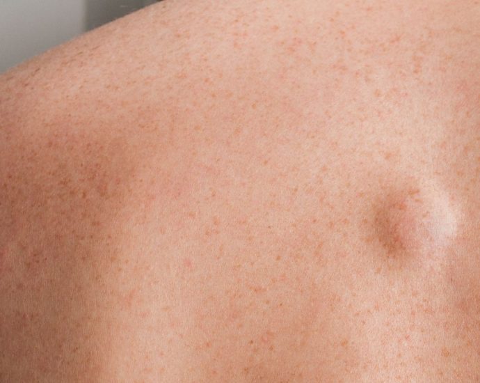 Tłuszczak na plecach